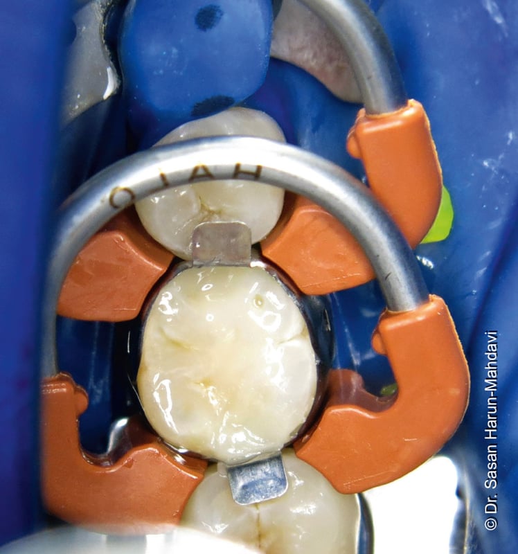 "Very well thoughtout" Review of new sectional matrix system